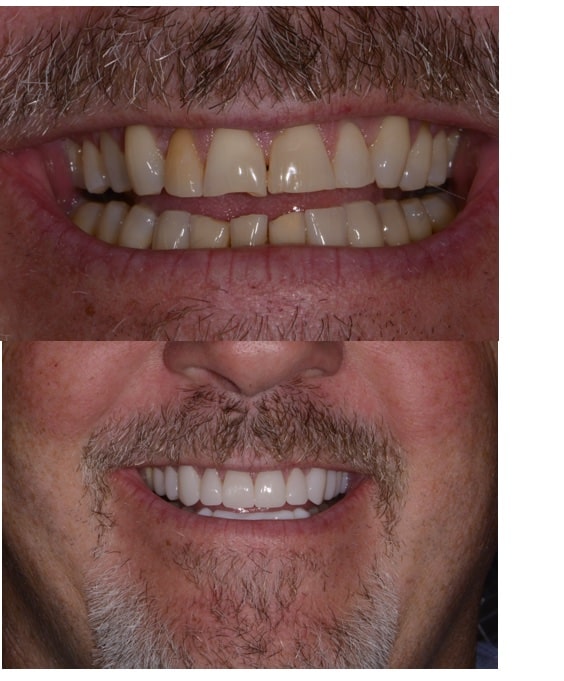 Before and After Image: Cosmetic Dentistry - front
