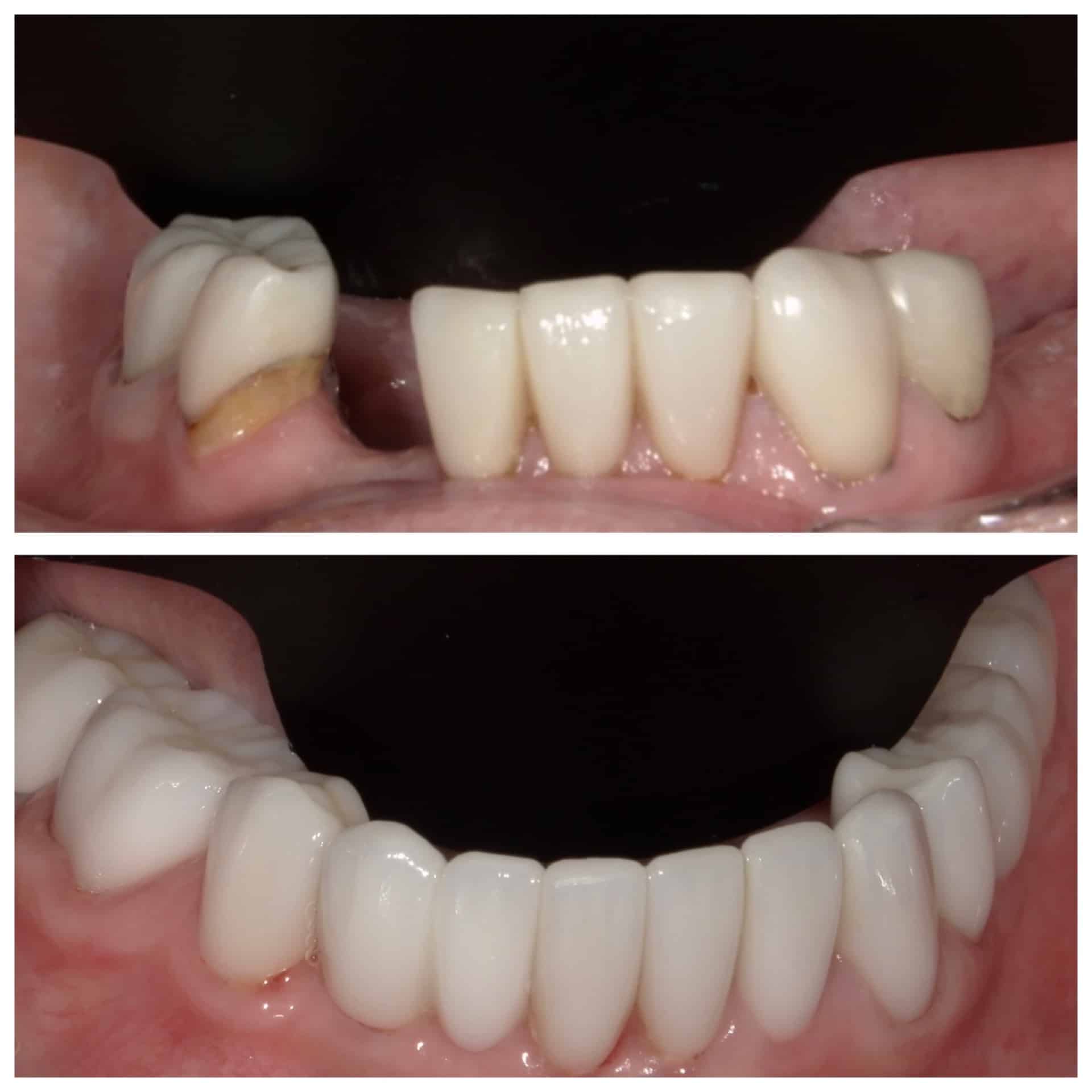 Before and After Image: Smile Rehabilitation - front