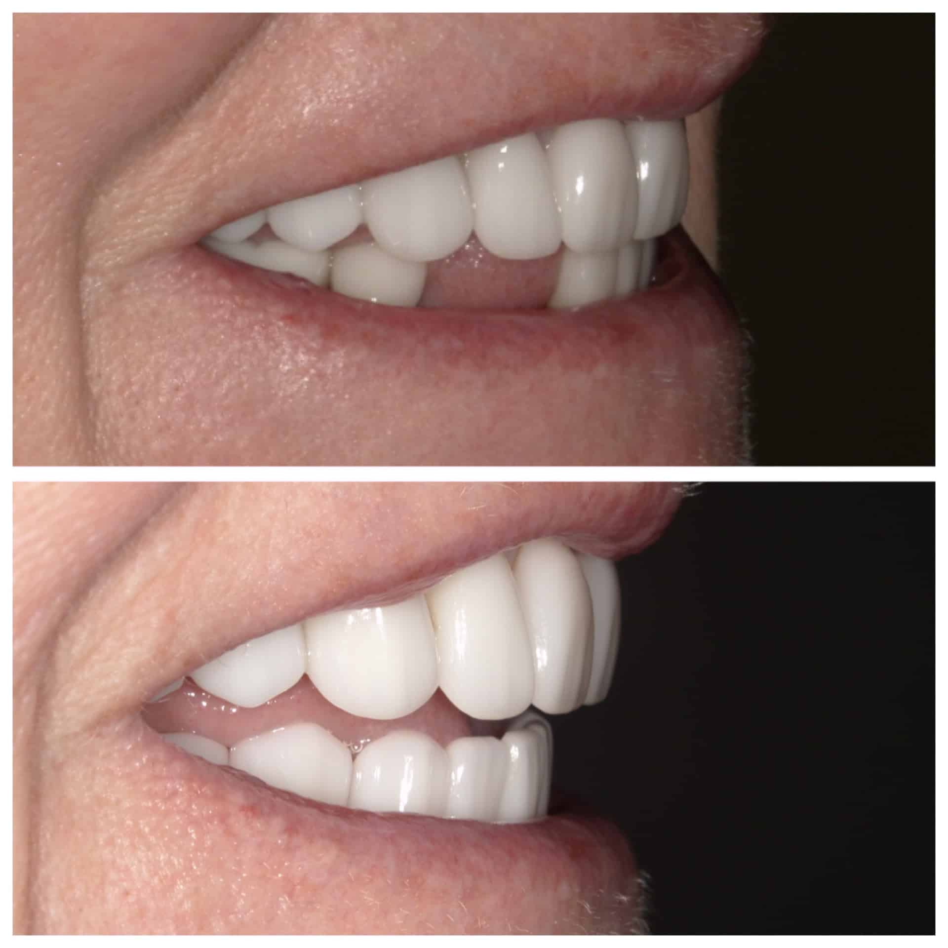 Before and After Image: Smile Rehabilitation - front