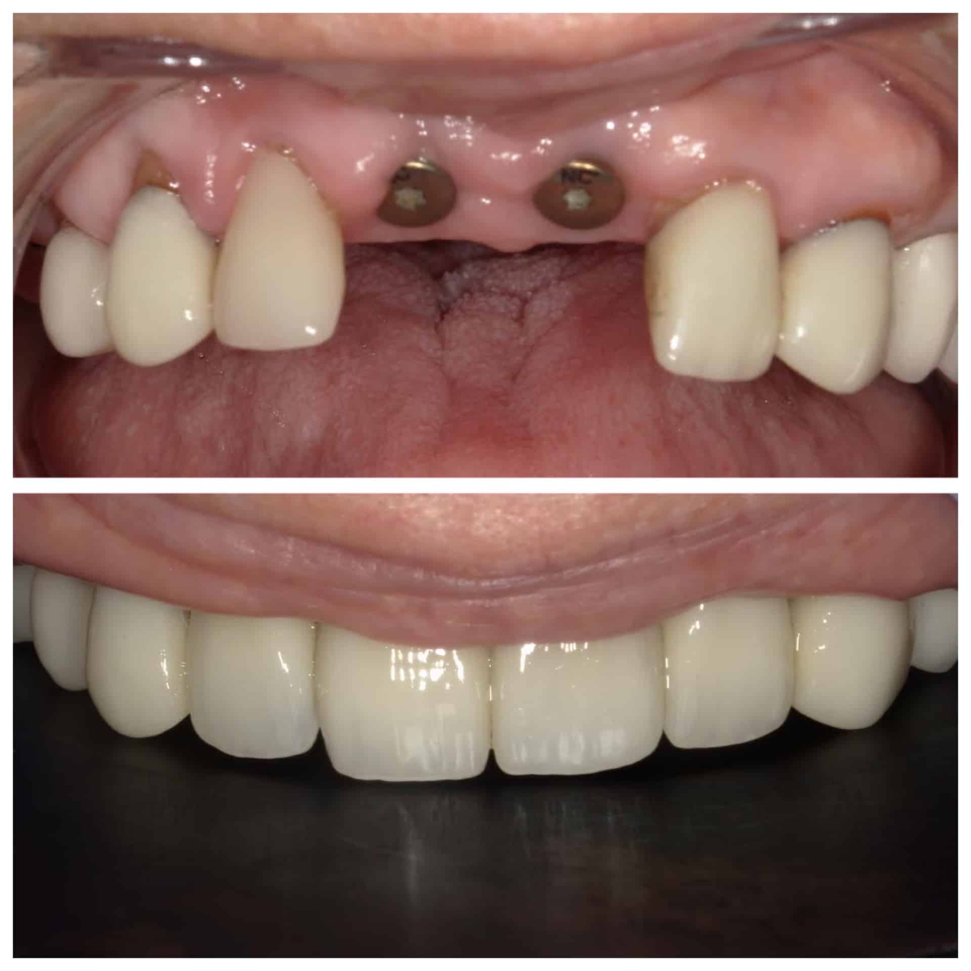 Before and After Image: Dental Implants -