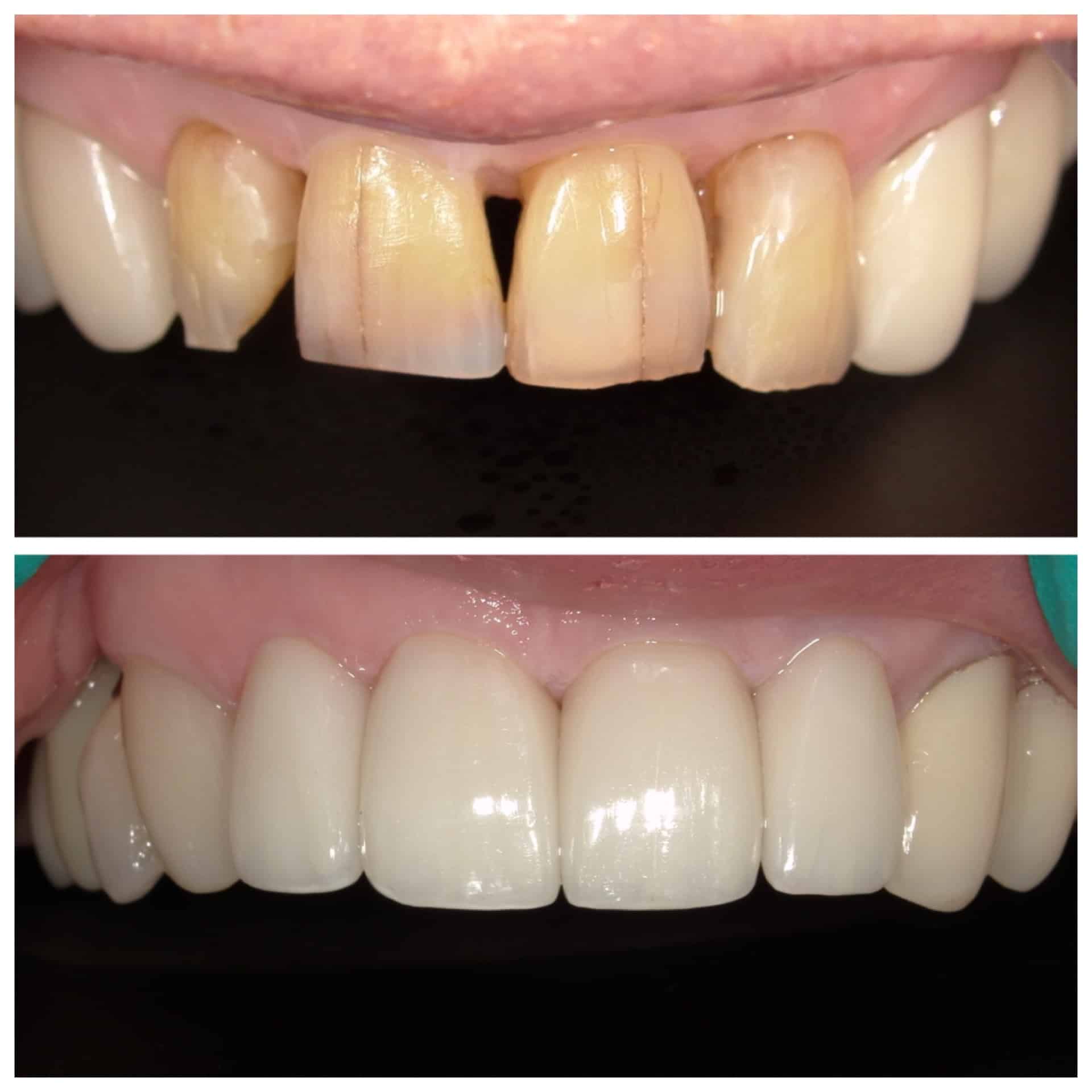 Before and After Image: Crowns - front