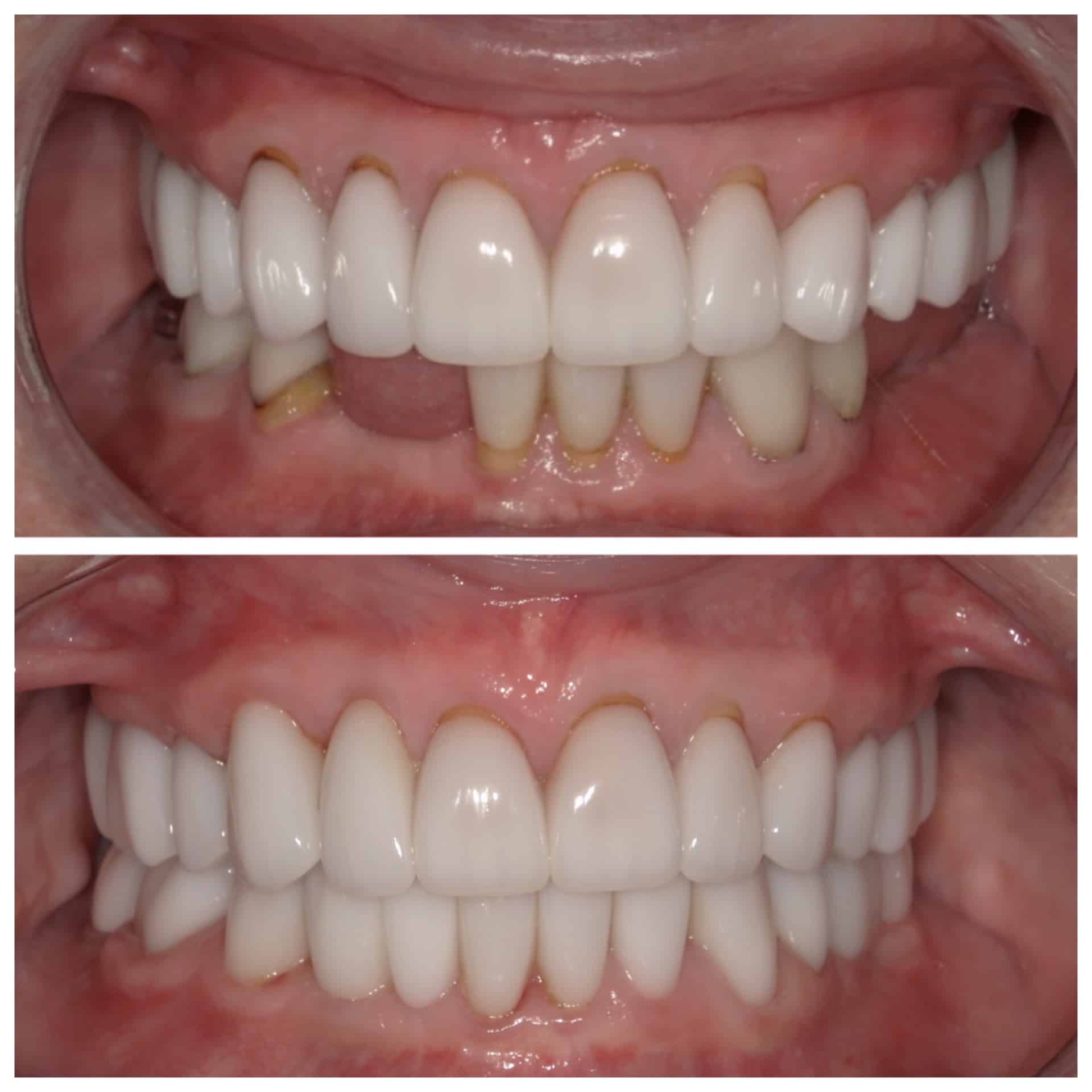 Before and After Image: Smile Rehabilitation - front
