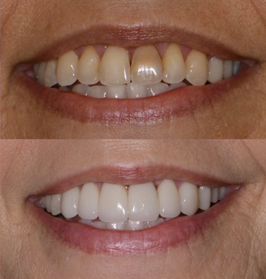 Before and After Image: Cosmetic Dentistry - front