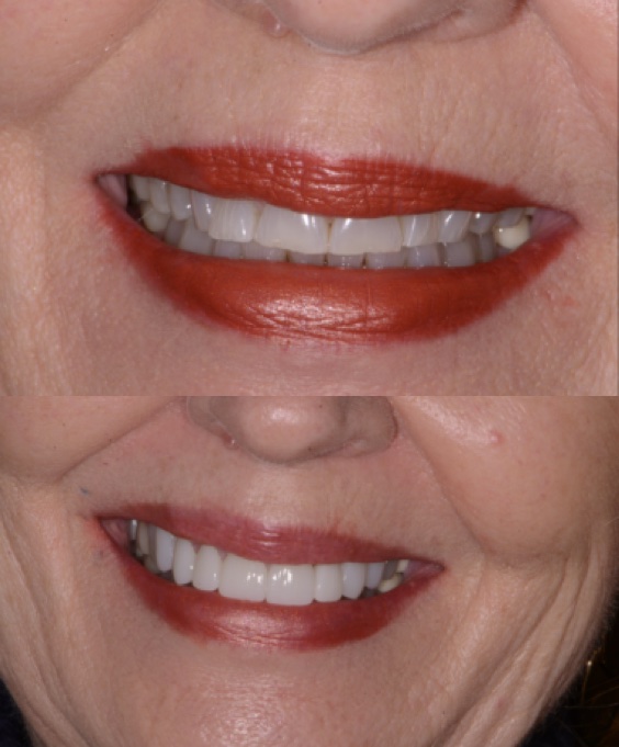 Before and After Image: Cosmetic Dentistry - front