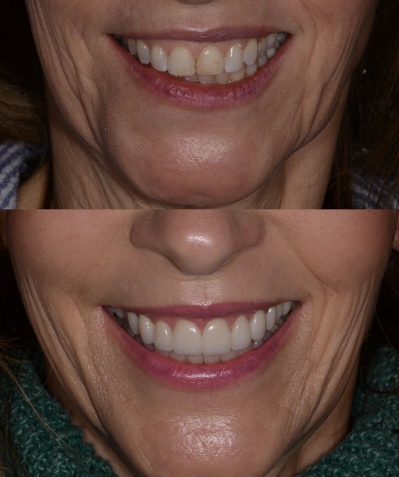 Before and After Image: Cosmetic Dentistry - front