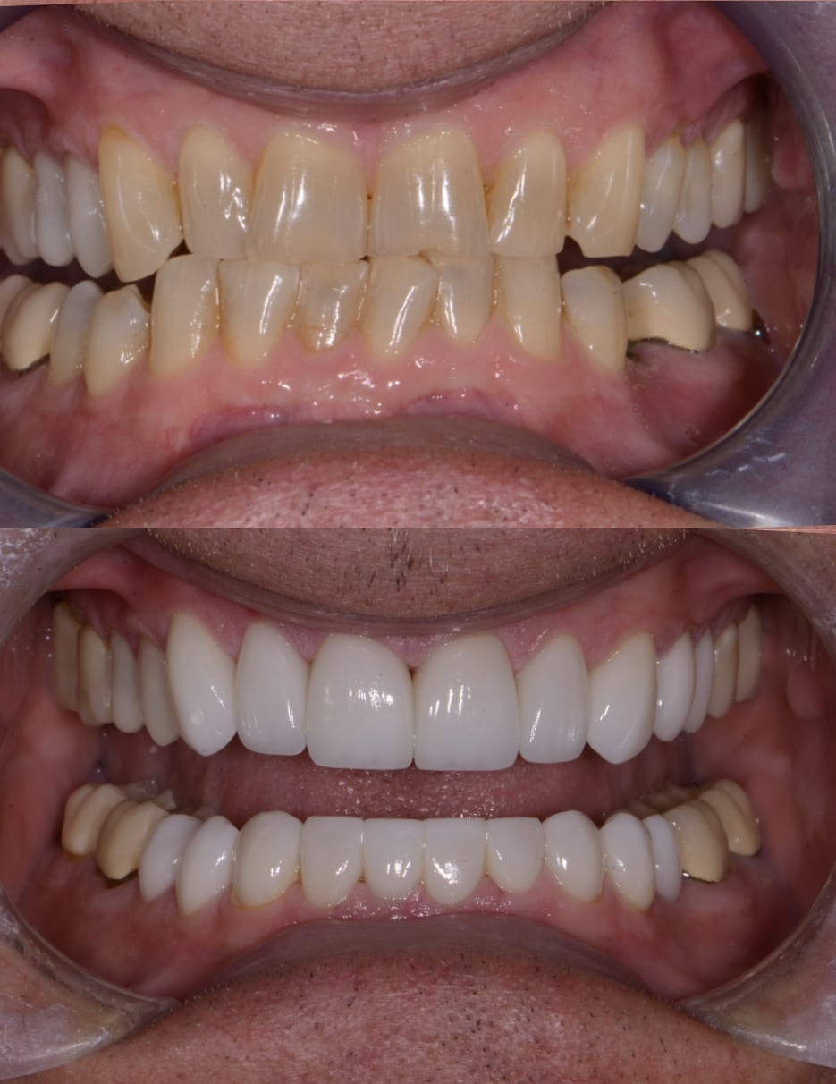 Before and After Image: Cosmetic Dentistry - front