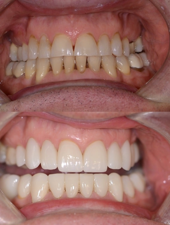 Before and After Image: Cosmetic Dentistry - front
