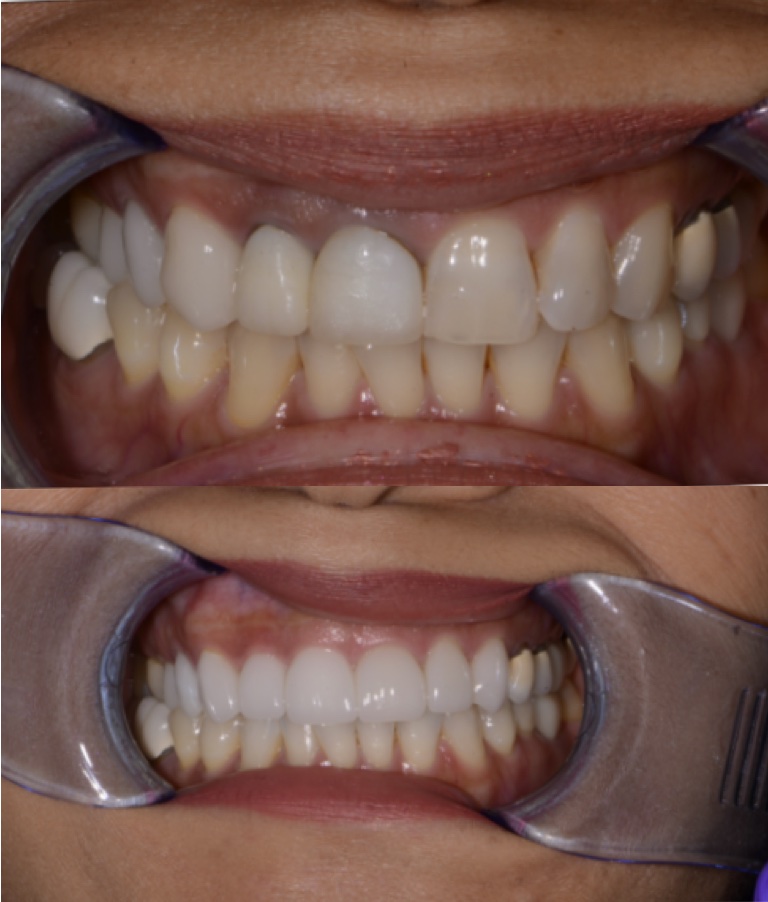 Before and After Image: Cosmetic Dentistry - front