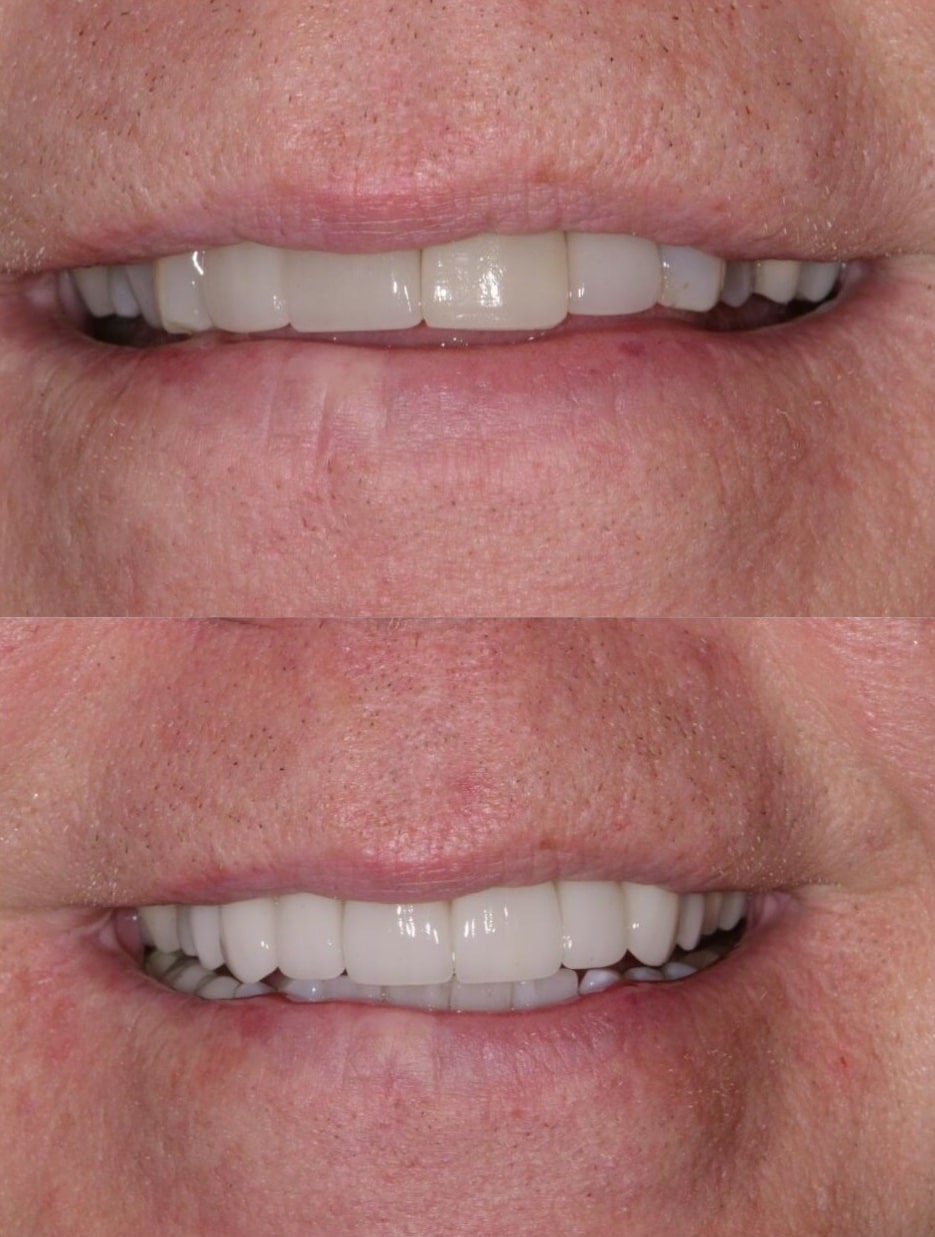 Before and After Image: Cosmetic Dentistry - front