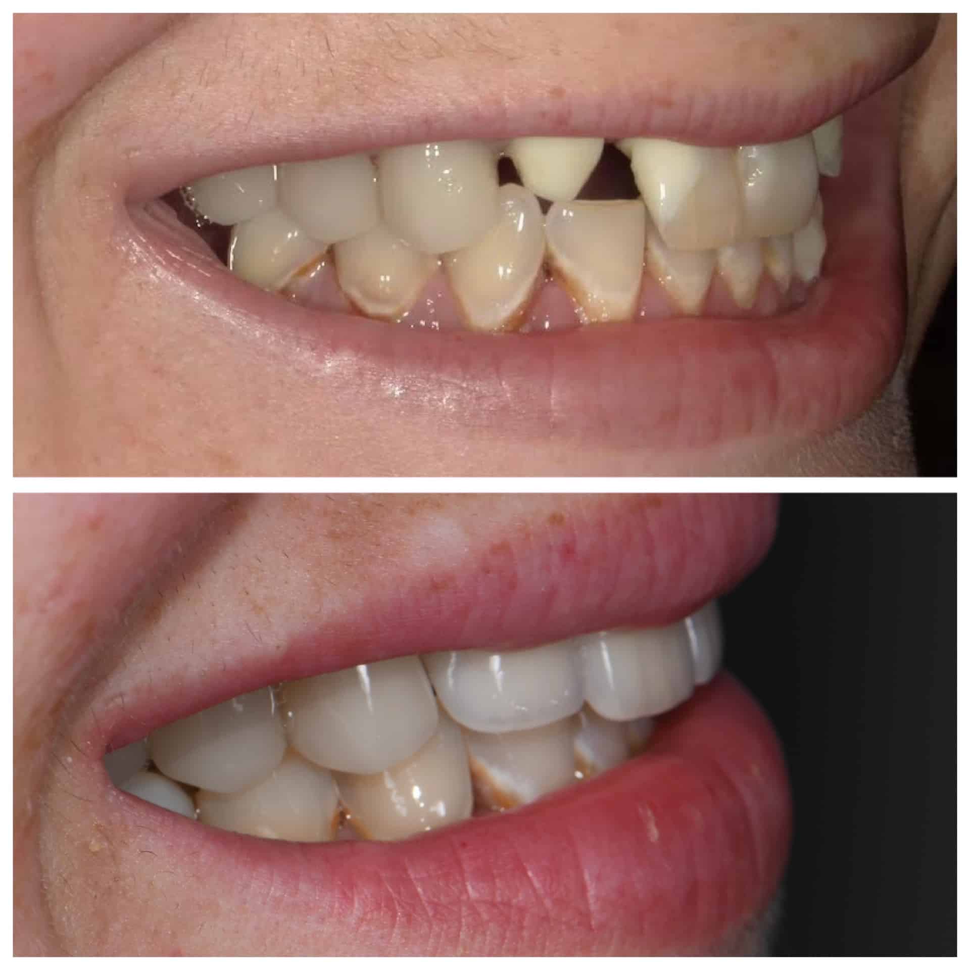 Before and After Image: Veneers, Crowns and Bridges - right-side