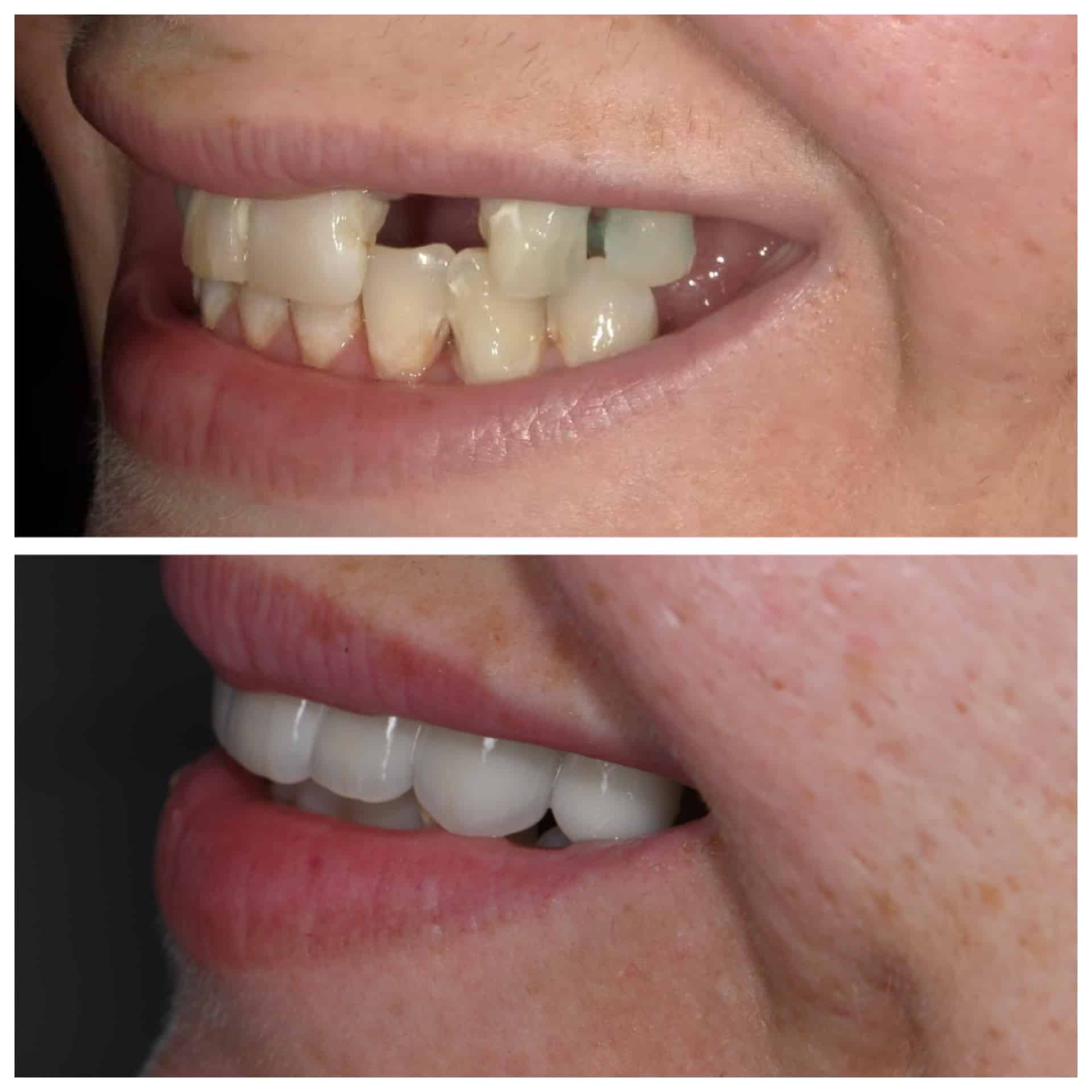 Before and After Image: Veneers, Crowns and Bridges - left-side
