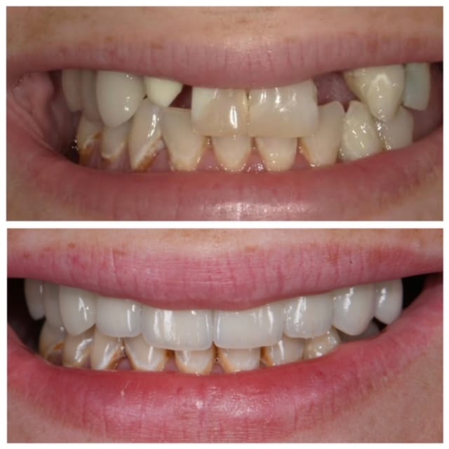 Before and After Image: Veneers, Crowns and Bridges - front
