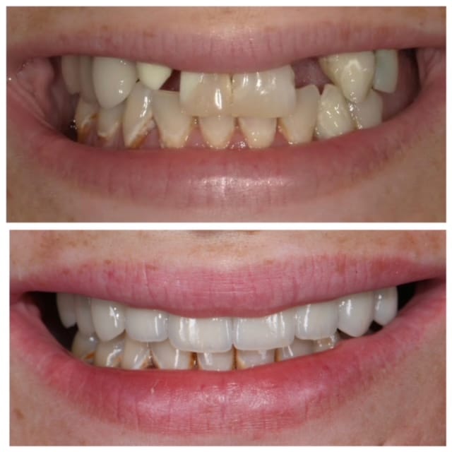 Before and After Image: Veneers, Crowns and Bridges -