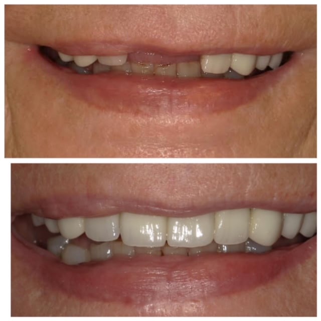 Before and After Image: Dental Implants - front