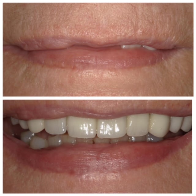Before and After Image: Dental Implants -