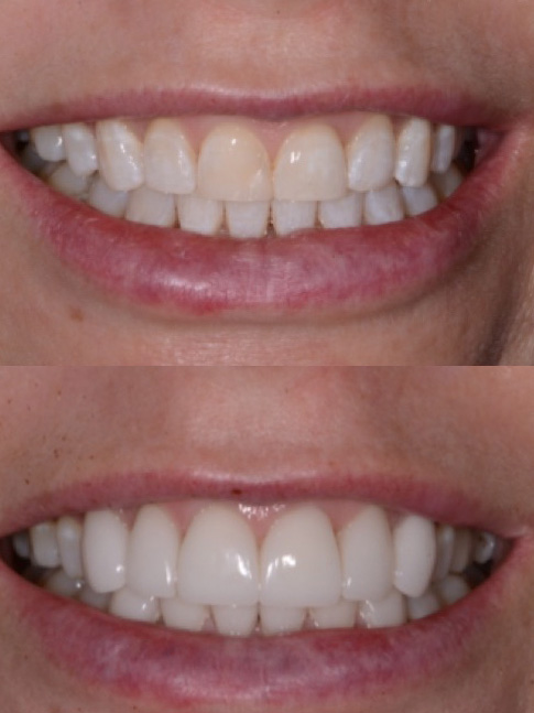 Before and After Image: Cosmetic Dentistry - front